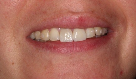 Close up of improved teeth after cosmetic dentistry from Brenda Berkal D M D