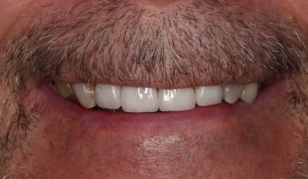 Close up of man smiling with brighter teeth