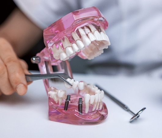 A dentist showing an implant bridge