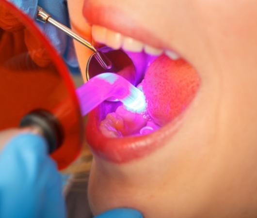 Dental patient getting bonding on their tooth hardened with curing light