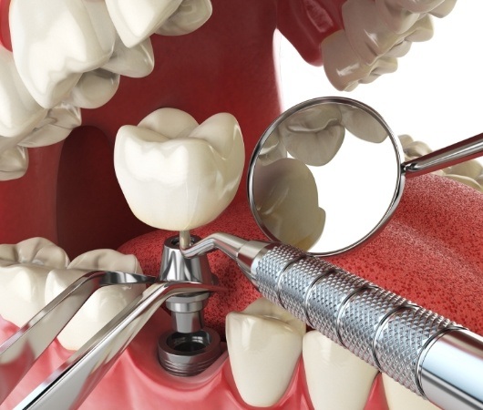 Model of dental implant being placed in the lower jaw