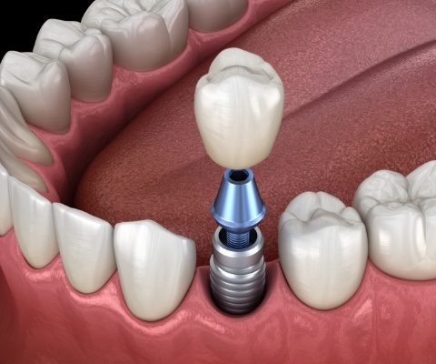 Illustrated dental crown being placed onto dental implant