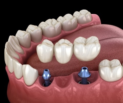 Illustrated dental bridge being placed onto two dental implants