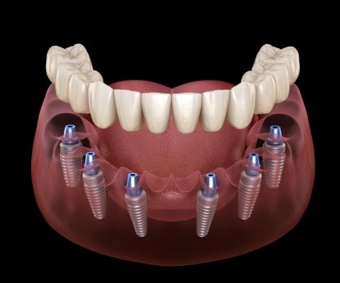 Illustrated denture being placed onto six dental implants