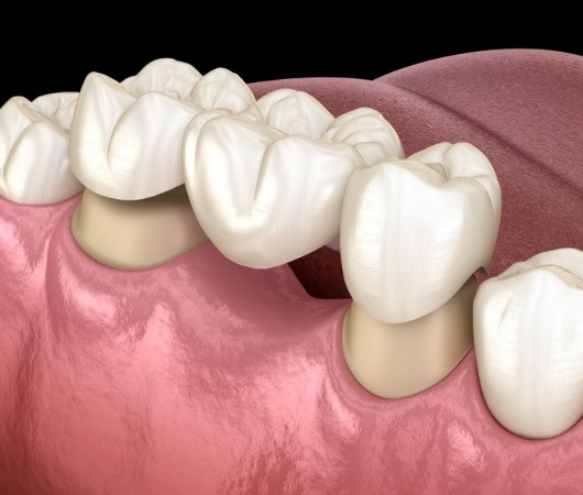 Illustrated dental bridge being fitted to replace missing tooth