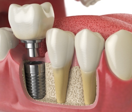 Illustrated dental crown being placed onto dental implant in lower jaw