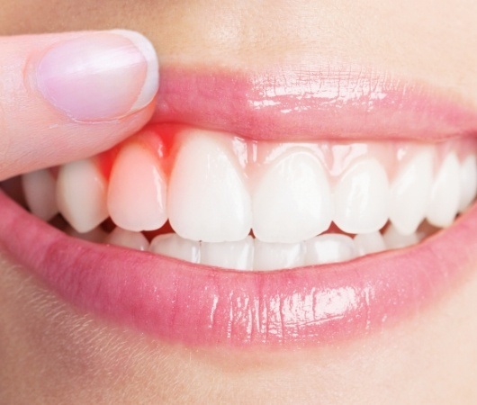 Close up of person pointing to red spot on their gums