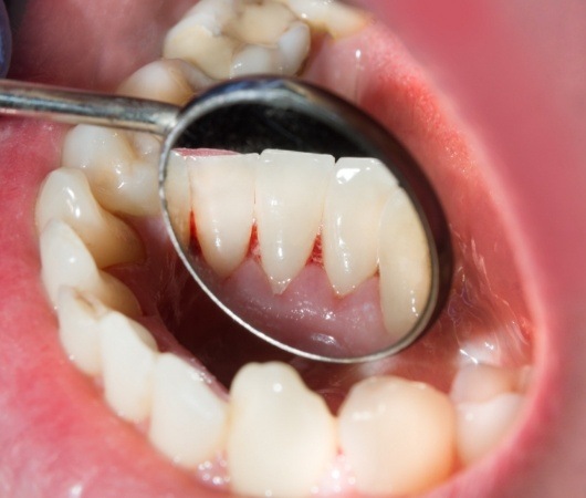 Close up of dental mirror showing red spot in mouth