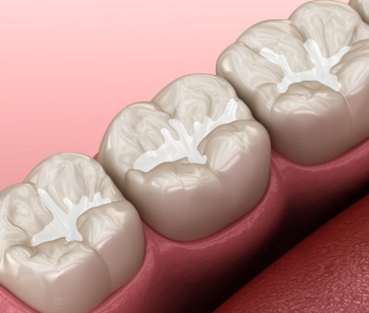 Illustrated row of teeth with barely noticeable dental sealants