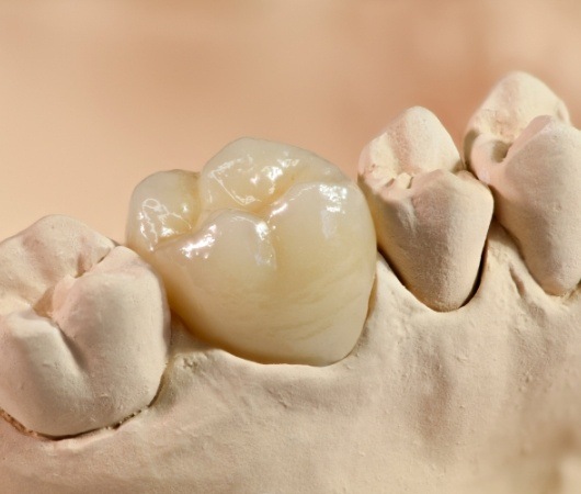 Model of the mouth with a dental crown over one tooth