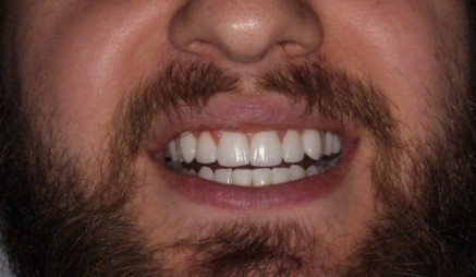 Close up of man after teeth whitening