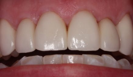 Close up of mouth with whiter teeth