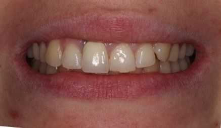 Close up of slightly uneven and discolored teeth