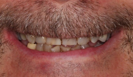 Close up of man smiling with stained teeth