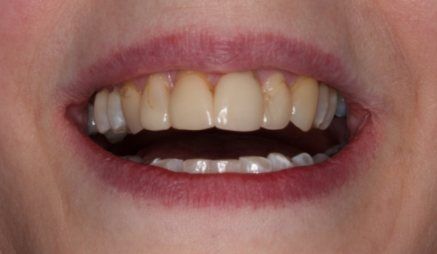 Close up of mouth with stained teeth